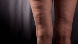FEMME ayant les jambes gonflées - rétention d'eau que faire