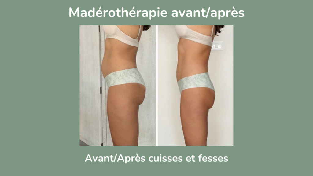 Madérothérapie fesses et cuisses avant après