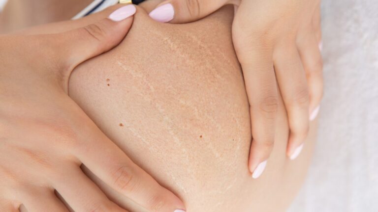 Comment différencier cellulite et rétention d'eau ?