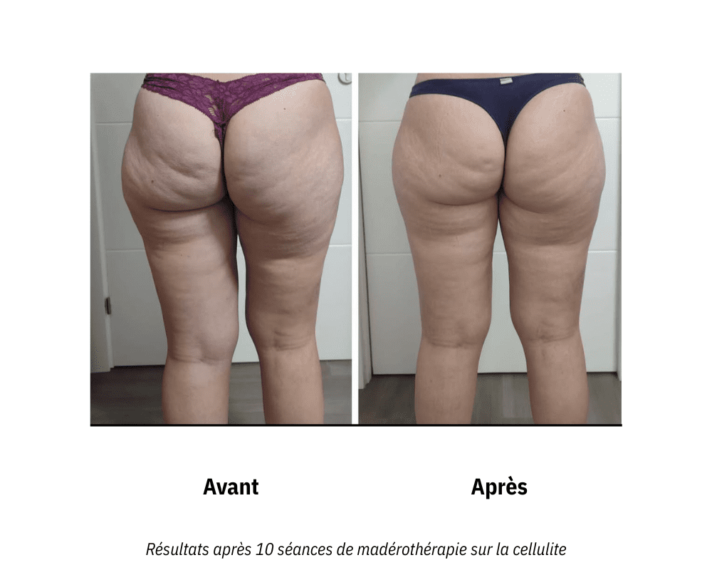Madérothérapie cellulite avant après : lissage de la peau d'orange et amélioration de la texture cutanée