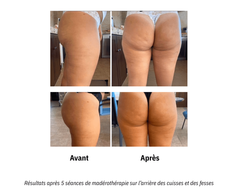 Madérothérapie cuisses et fessiers avant après : raffermissement de la peau et lissage de la cellulite