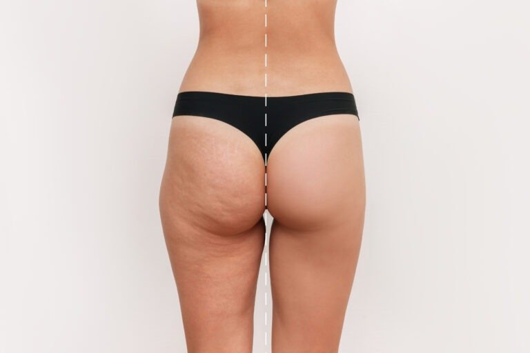cellulite fesse