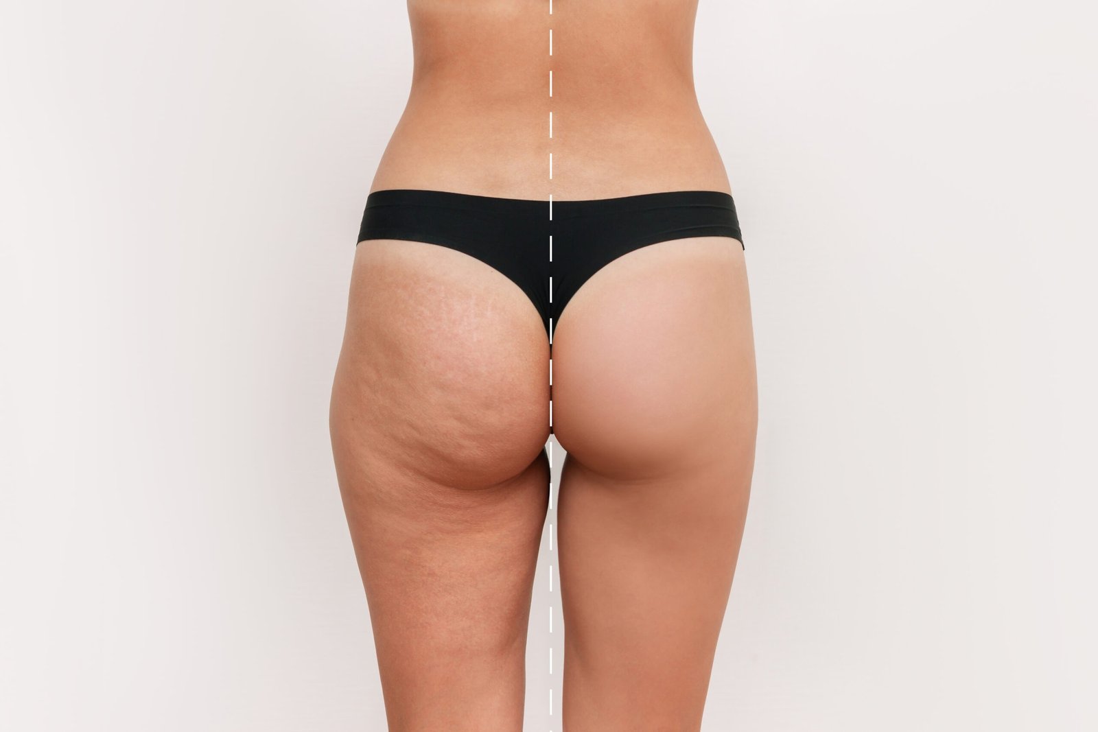 cellulite fesse
